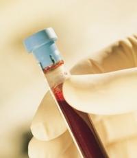 Мочевая кислота в крови: норма, причины повышенного и пониженного уровня, что делать